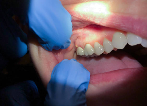 Best Emergency Tooth Extraction in Palmyra, IN